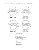 Joint Arthroplasty Devices Formed In Situ diagram and image