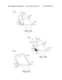 FILLING UNDERCUT AREAS OF TEETH RELATIVE TO AXES OF APPLIANCE PLACEMENT diagram and image