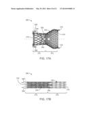 Prosthetic Valve Crimping diagram and image