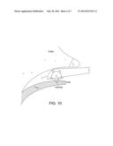 METHODS AND DEVICES SUITABLE FOR IMPROVED REATTACHMENT OF DETACHED     CARTILAGE TO SUBCHONDRAL BONE diagram and image