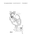 INTRAVASCULAR VENTRICULAR ASSIST DEVICE diagram and image