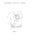 Combination Heart Assist Systems, Methods, and Devices diagram and image