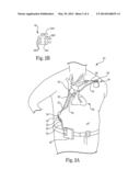 Combination Heart Assist Systems, Methods, and Devices diagram and image