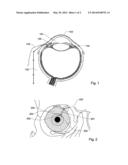 A DEVICE FOR ADJUSTING THE INTRAOCULAR PRESSURE diagram and image
