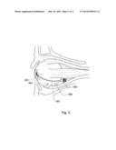 A DEVICE FOR ADJUSTING THE INTRAOCULAR PRESSURE diagram and image