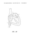 SUTURING DEVICES AND METHODS FOR SUTURING AN ANATOMIC VALVE diagram and image