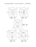 SUTURING DEVICES AND METHODS FOR SUTURING AN ANATOMIC VALVE diagram and image