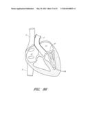 SUTURING DEVICES AND METHODS FOR SUTURING AN ANATOMIC VALVE diagram and image