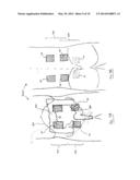 TRANSCUTANEOUS STIMULATION METHOD AND SYSTEM diagram and image