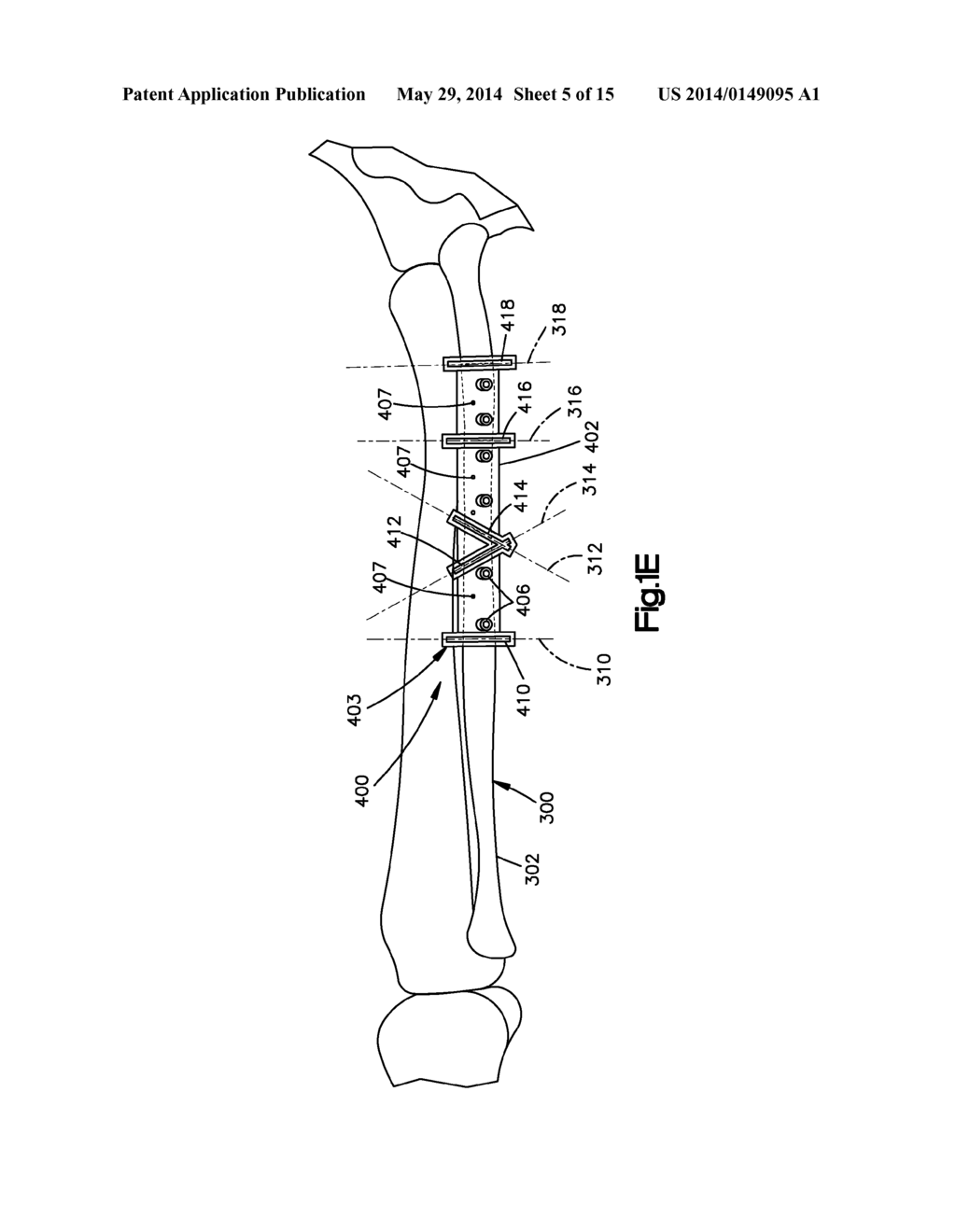 Surgical Guides from Scanned Implant Data - diagram, schematic, and image 06