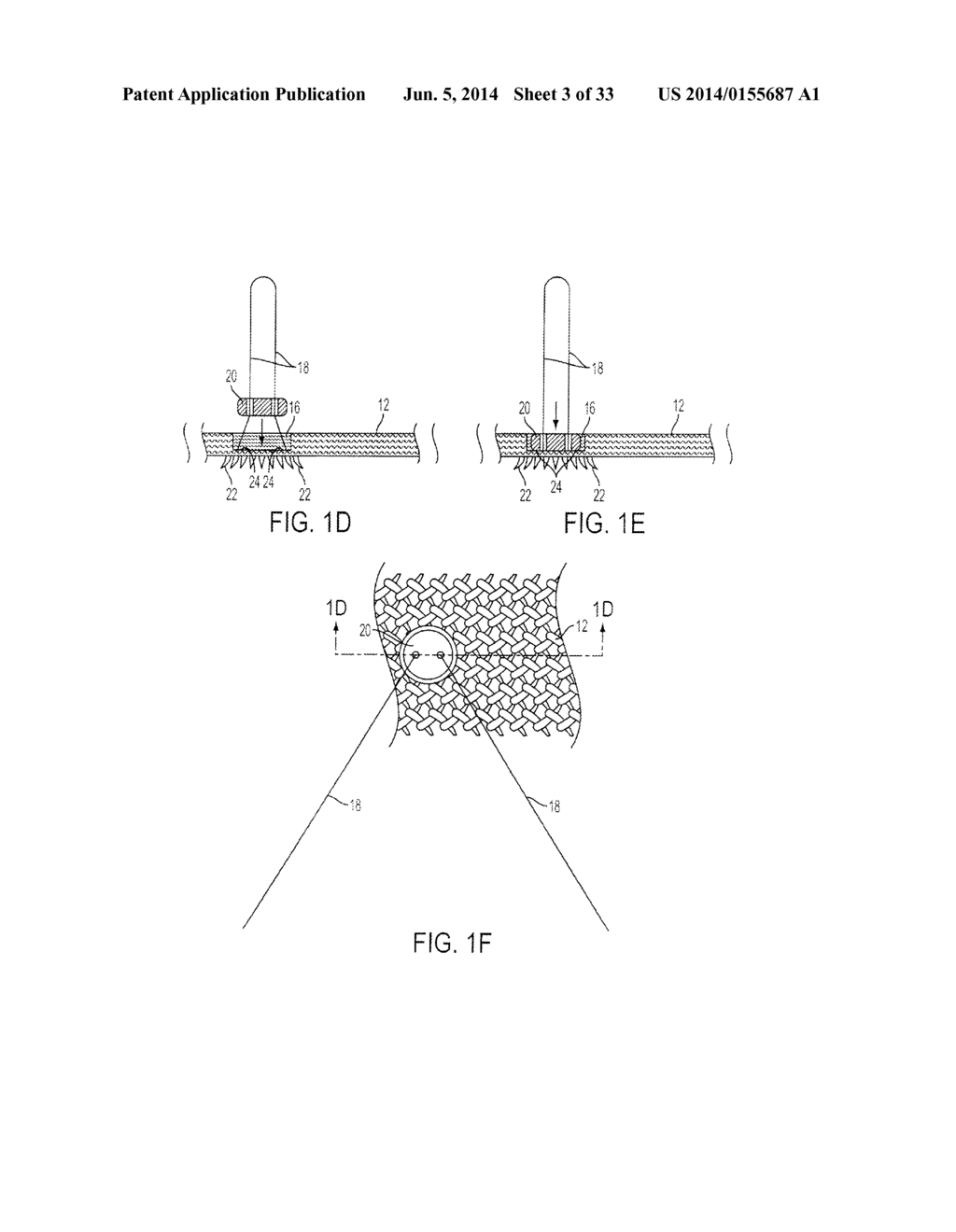 ATRAUMATIC MEDICAL DEVICE ANCHORING AND DELIVERY SYSTEM WITH ENHANCED     ANCHORING - diagram, schematic, and image 04