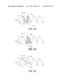 METHODS AND SYSTEMS THAT MONITOR FOR AN IMPENDING MYOCARDIAL INFARCTION diagram and image