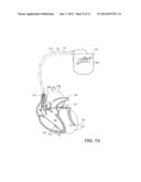 METHODS AND SYSTEMS THAT MONITOR FOR AN IMPENDING MYOCARDIAL INFARCTION diagram and image