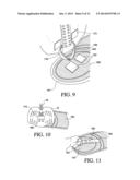 THORACIC LUMBAR SACRAL ORTHOSIS diagram and image