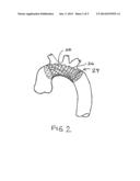 EMBOLIC PROTECTION DEVICE diagram and image