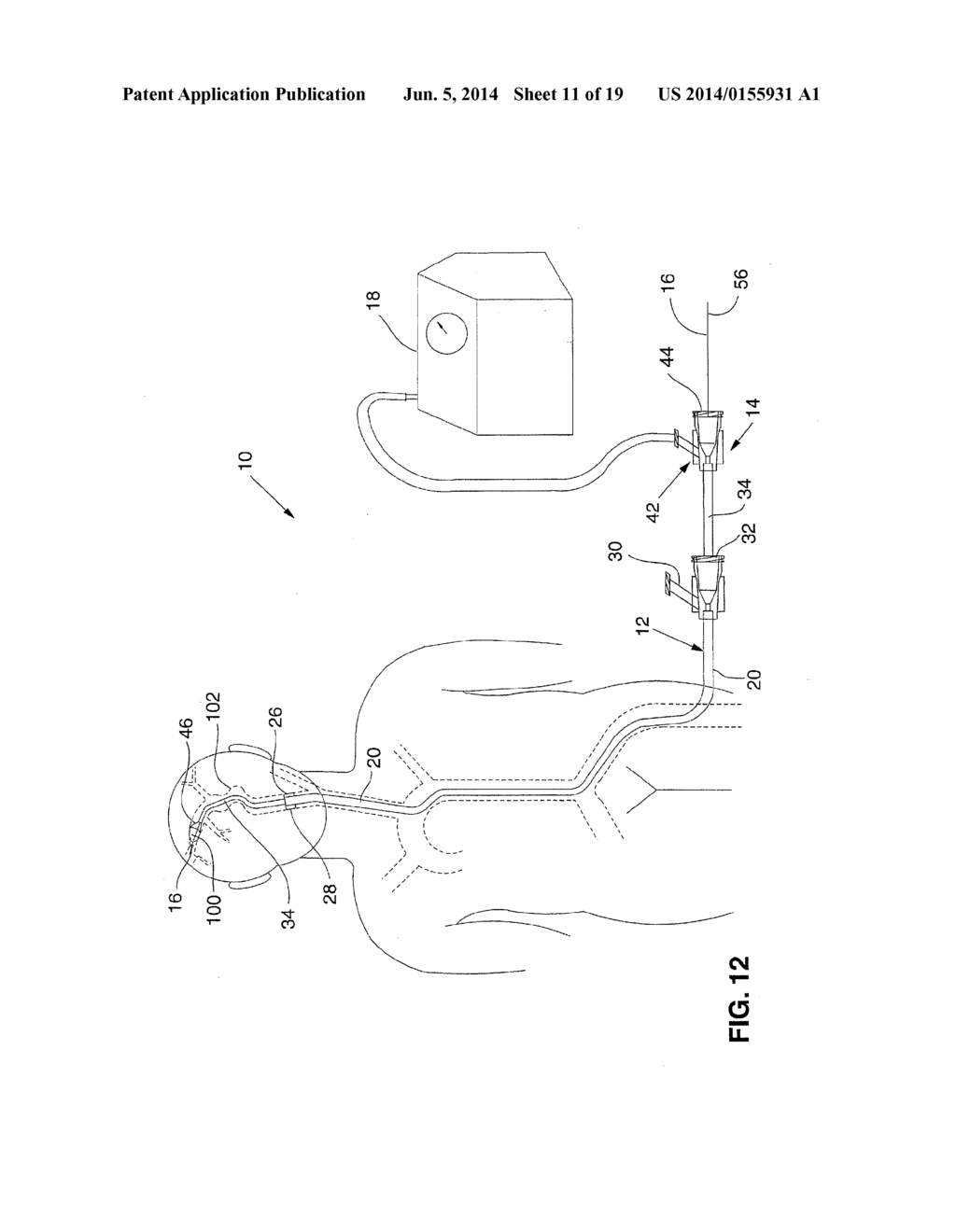 SYSTEM AND METHOD FOR TREATING ISCHEMIC STROKE - diagram, schematic, and image 12