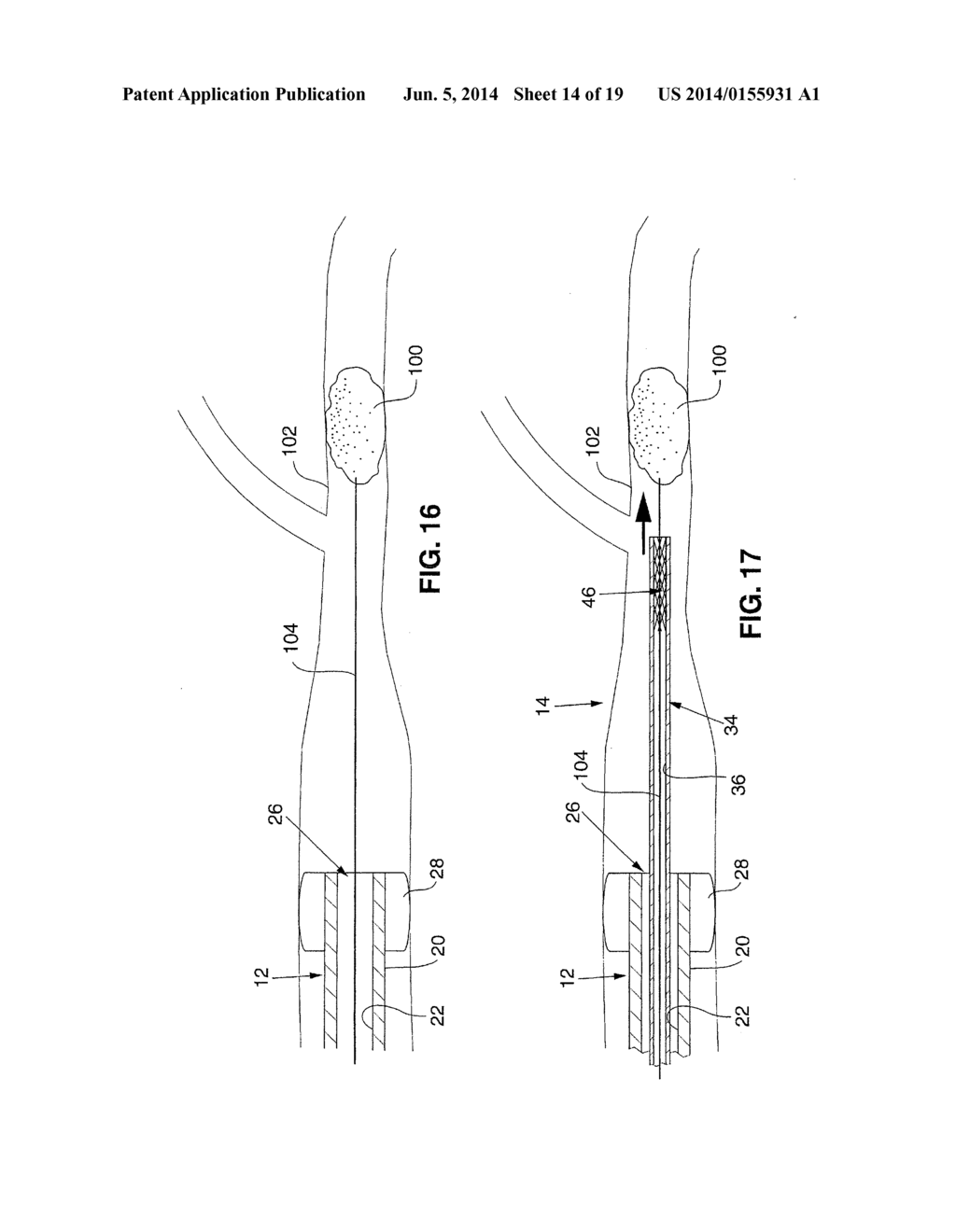 SYSTEM AND METHOD FOR TREATING ISCHEMIC STROKE - diagram, schematic, and image 15