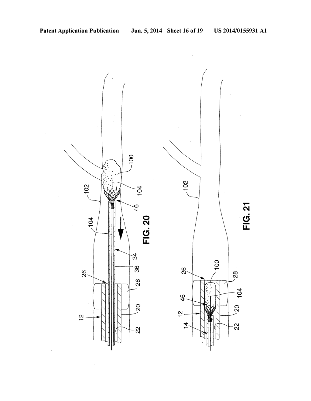 SYSTEM AND METHOD FOR TREATING ISCHEMIC STROKE - diagram, schematic, and image 17