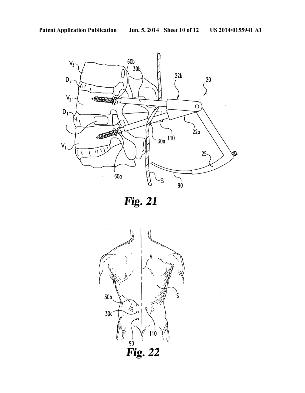 INSTRUMENTS AND METHODS FOR STABILIZATION OF BONY STRUCTURES - diagram, schematic, and image 11