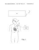 MRI CONDITIONALLY SAFE LEAD WITH LOW-PROFILE CONDUCTOR FOR LONGITUDINAL     EXPANSION diagram and image