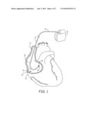 ACTIVE FIXATION LEAD HAVING A ROTATABLE CURVE diagram and image