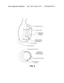 CARDIAC RHYTHM MANAGEMENT SYSTEM WITH INTRAMURAL MYOCARDIAL PACING LEADS     AND ELECTRODES diagram and image