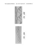 EXPANDABLE TIP ASSEMBLY FOR THROMBUS MANAGEMENT diagram and image