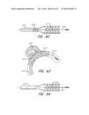 EXPANDABLE TIP ASSEMBLY FOR THROMBUS MANAGEMENT diagram and image