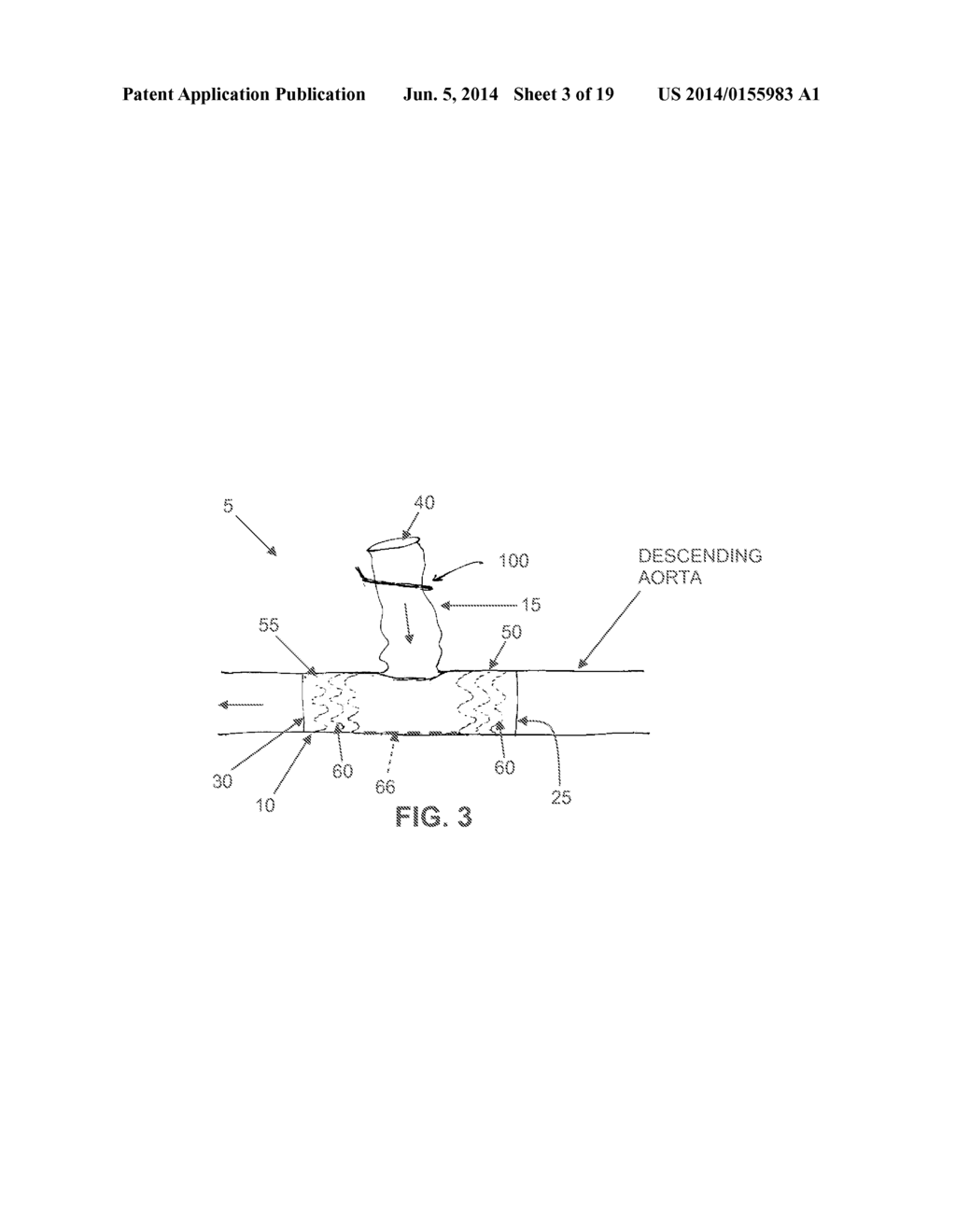 METHOD AND APPARATUS FOR EFFECTING AN AORTIC VALVE BYPASS, INCLUDING THE     PROVISION AND USE OF A T-STENT FOR EFFECTING A DISTAL ANASTOMOSIS FOR THE     SAME - diagram, schematic, and image 04