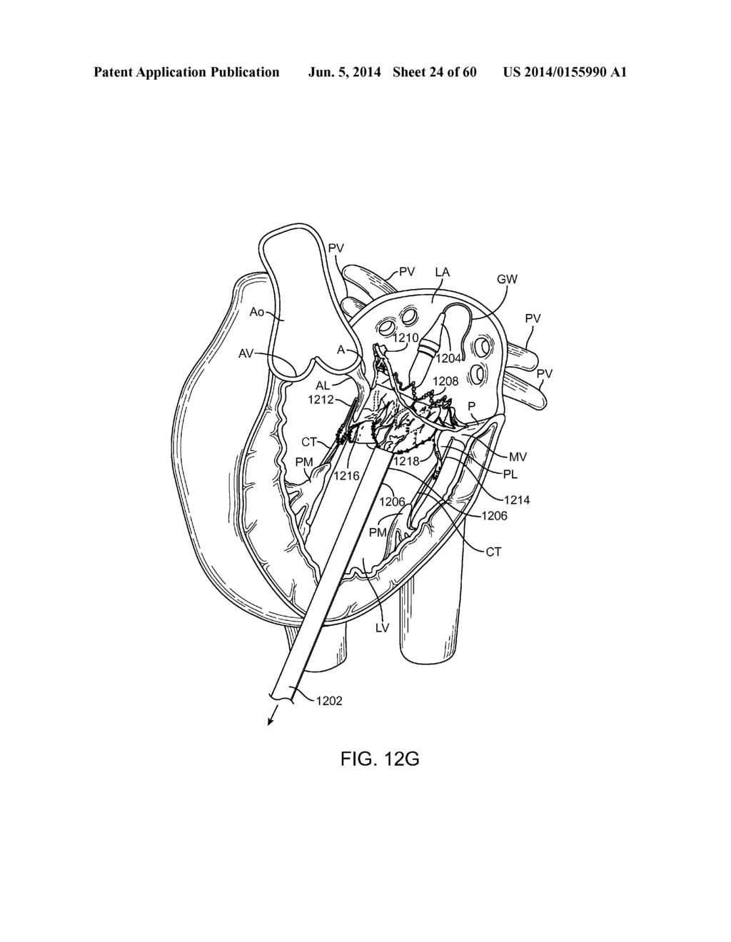 METHODS AND APPARATUS FOR LOADING A PROSTHESIS ONTO A DELIVERY SYSTEM - diagram, schematic, and image 25