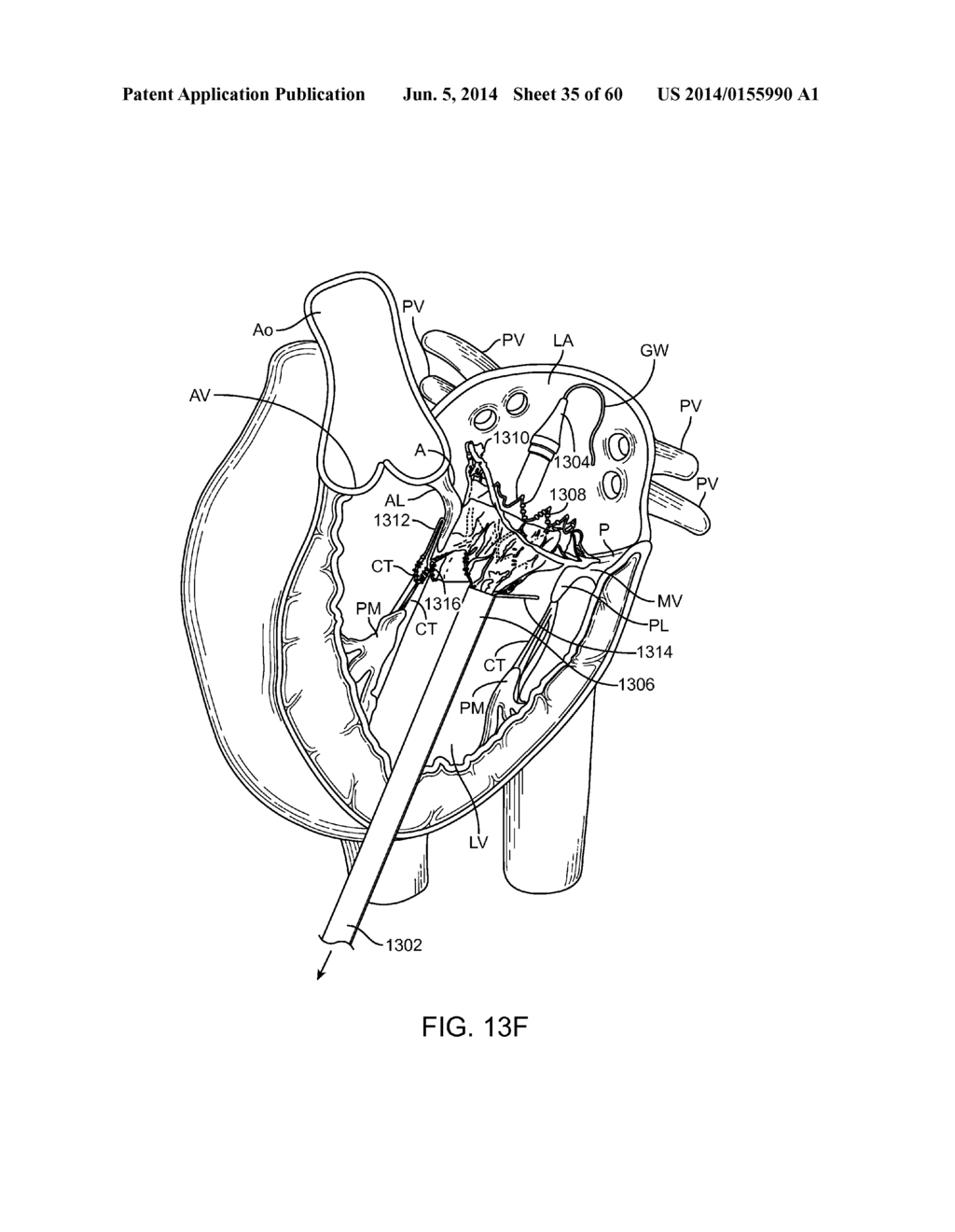 METHODS AND APPARATUS FOR LOADING A PROSTHESIS ONTO A DELIVERY SYSTEM - diagram, schematic, and image 36