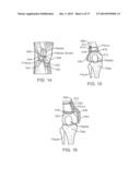 Method and Apparatus for Altering Biomechanics of the Articular Joints diagram and image