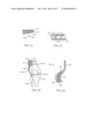 Method and Apparatus for Altering Biomechanics of the Articular Joints diagram and image