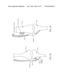 Method and Apparatus for Altering Biomechanics of the Articular Joints diagram and image