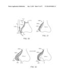 Method and Apparatus for Altering Biomechanics of the Articular Joints diagram and image