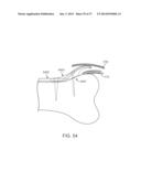 Method and Apparatus for Altering Biomechanics of the Articular Joints diagram and image