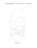 FLEX ANCHOR FOR ATTACHING A PROSTHESIS TO BONE diagram and image