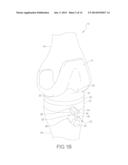 FLEX ANCHOR FOR ATTACHING A PROSTHESIS TO BONE diagram and image