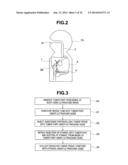 TUMOR TISSUE REDUCTIVE PROCEDURE UNDER ULTRASOUND OBSERVATION diagram and image