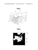 TUMOR TISSUE REDUCTIVE PROCEDURE UNDER ULTRASOUND OBSERVATION diagram and image