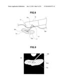 TUMOR TISSUE REDUCTIVE PROCEDURE UNDER ULTRASOUND OBSERVATION diagram and image