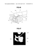 TUMOR TISSUE REDUCTIVE PROCEDURE UNDER ULTRASOUND OBSERVATION diagram and image