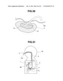 TUMOR TISSUE REDUCTIVE PROCEDURE UNDER ULTRASOUND OBSERVATION diagram and image