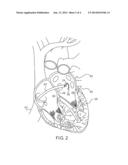 LASSO CATHETER WITH TIP ELECTRODE diagram and image