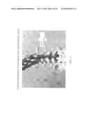 DETERMINING AND PLACING SPINAL IMPLANTS OR PROSTHESES diagram and image