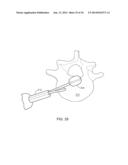 DETERMINING AND PLACING SPINAL IMPLANTS OR PROSTHESES diagram and image