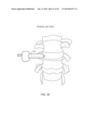 DETERMINING AND PLACING SPINAL IMPLANTS OR PROSTHESES diagram and image