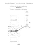 DETERMINING AND PLACING SPINAL IMPLANTS OR PROSTHESES diagram and image