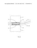 DETERMINING AND PLACING SPINAL IMPLANTS OR PROSTHESES diagram and image