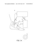 MINIMALLY INVASIVE IMPLANTABLE NEUROSTIMULATION SYSTEM diagram and image